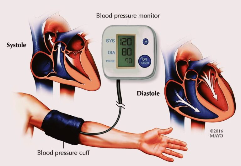 Hypertension during pregnancy