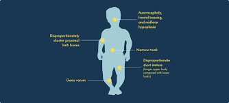 Achondroplasia in Babies, Causes and Treatment Options