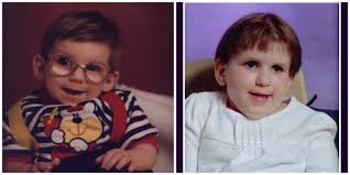 Cockayne Syndrome in Babies, Disorder, Diagnosis, and Management