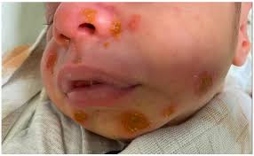 Hospital-Acquired Syndrome in Babies