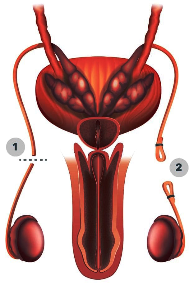 Male Vasectomy: Why, How Much of Success, vs How Much of Cost.