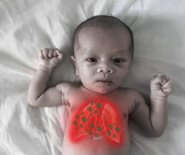 Pneumonia in babies