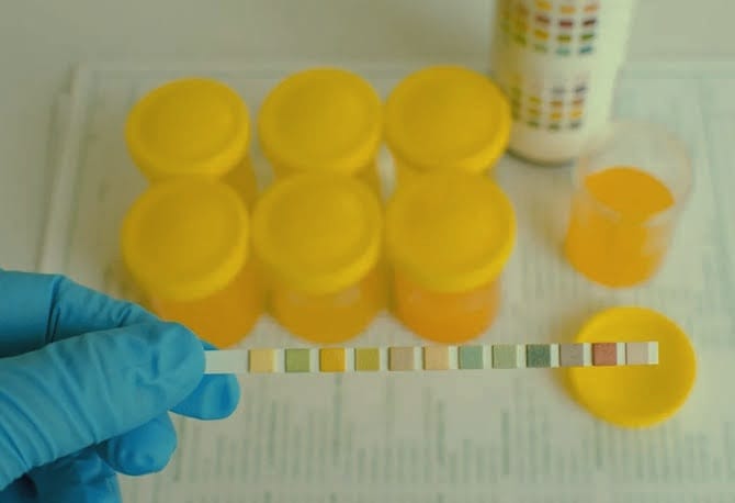 Proteinuria in Pregnancy