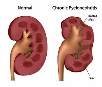 Kidney Infections in Pregnancy