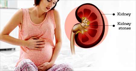 Kidney Stones and Pregnancy
