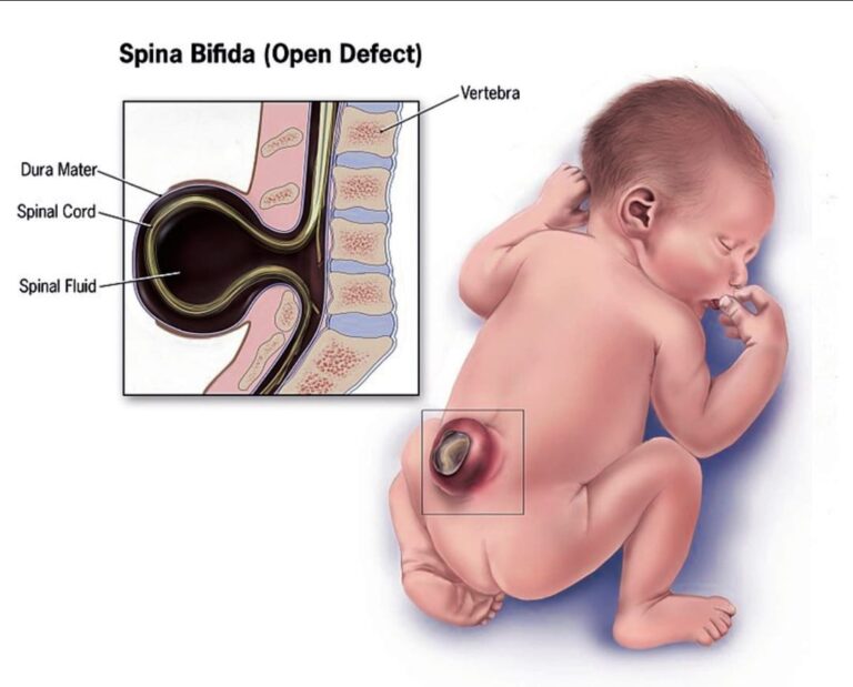 Spina Bifida in Babies, Causes, Symptoms, and Management