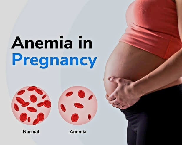 Anemia in Pregnancy