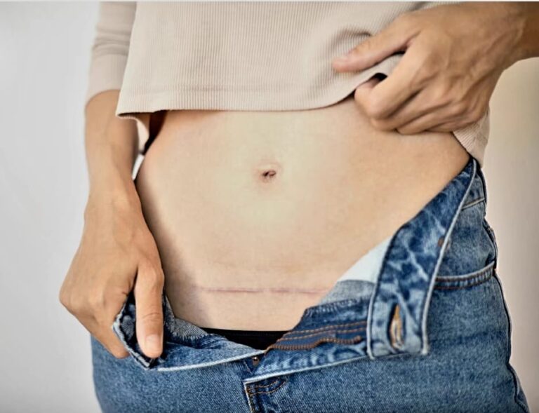 Scars after C-section